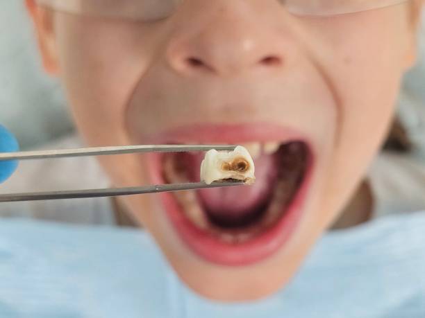 Best Emergency Dentist for Knocked-Out Tooth in Nolensville, TN